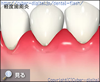 歯周病の進行